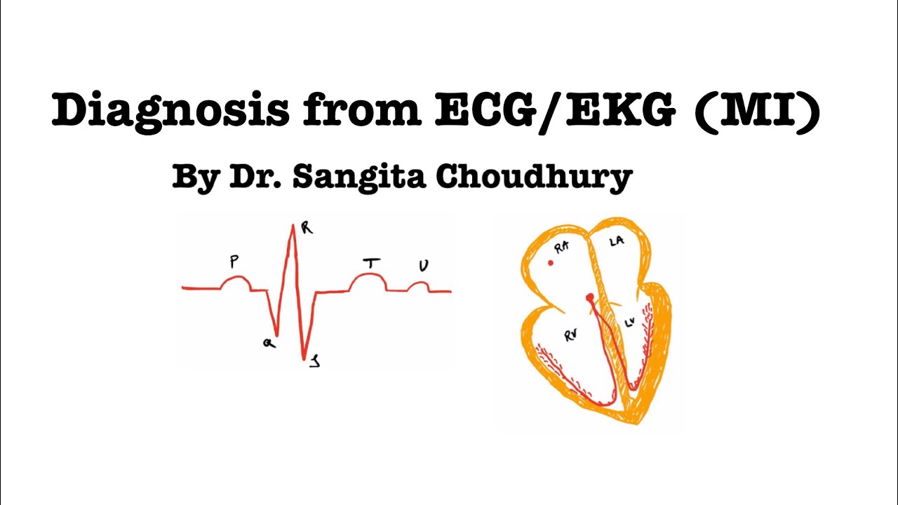 Diagnosis from ECG/EKG (MI) #MI #ECGtutorial #STEMI #ECGdiagnosis #solvingECG #cardiology