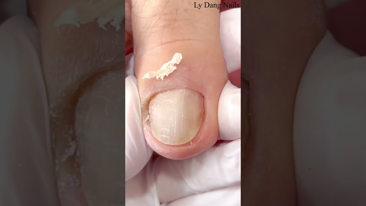 Lấy khoé móng chân siêu to | Ly Đặng Nails