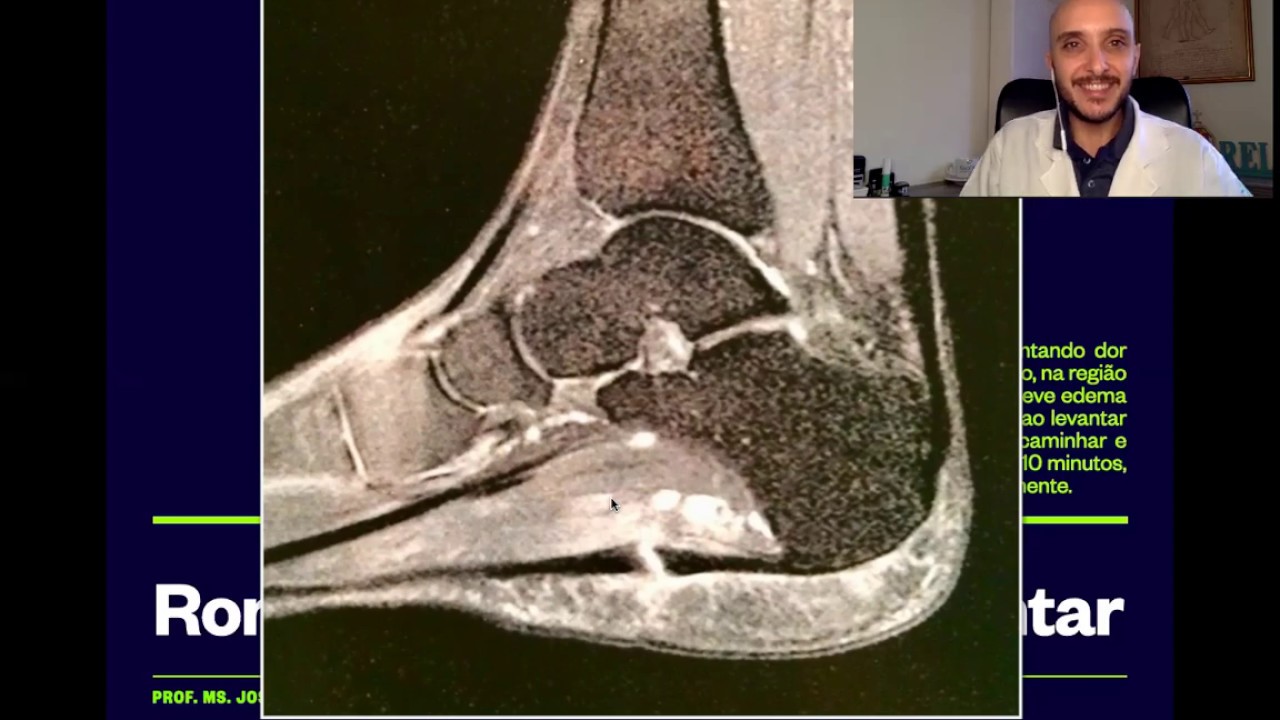 Ressonância magnética de rompimento de fáscia plantar