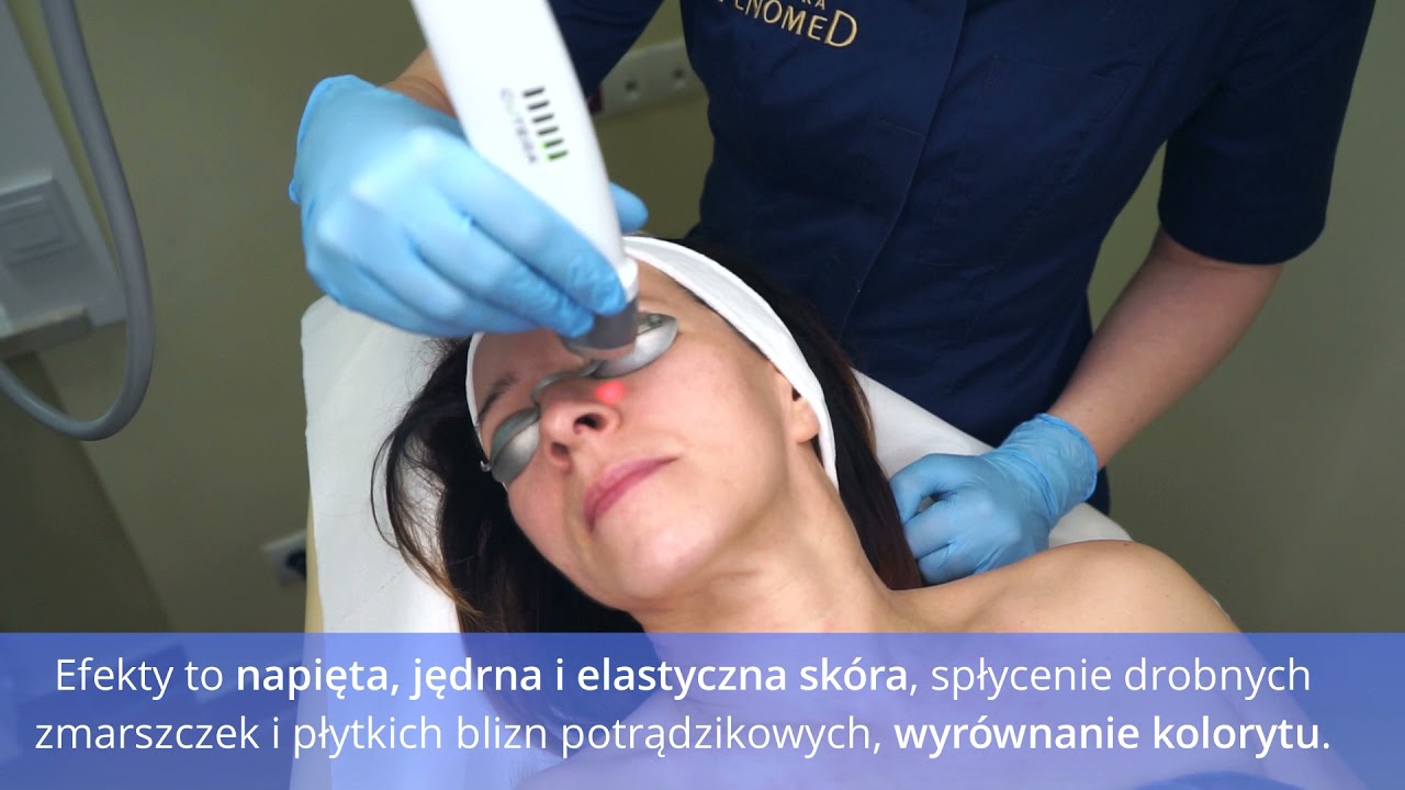 Laser Genesis - termolifting bez b&oacute;lu - jak wygląda zabieg?