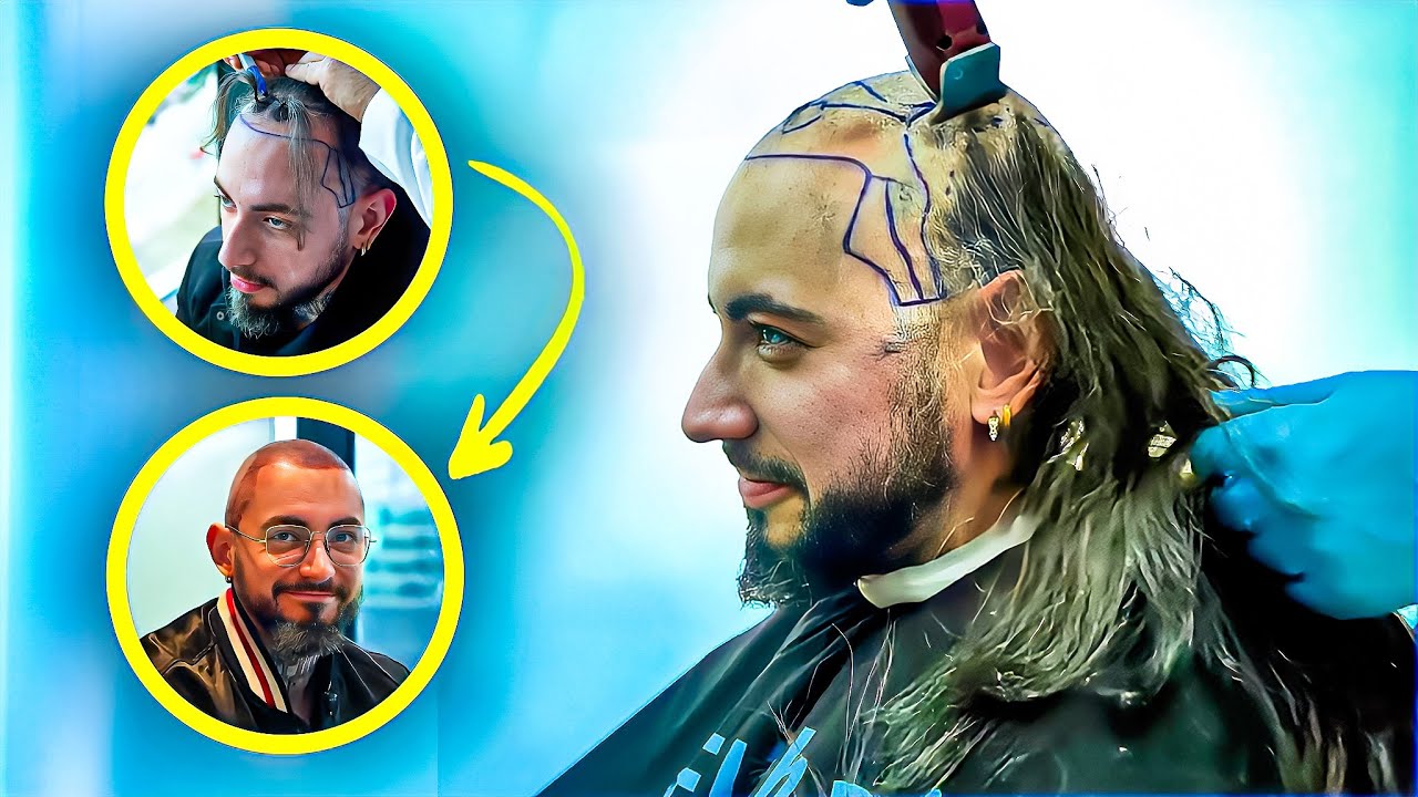 Simba réalise le rêve de Sergio : une greffe de cheveux chez Elithair ! 🔥