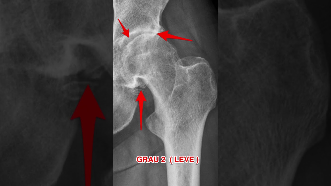 Voc&ecirc; sabe qual &eacute; o grau da sua artrose do quadril? #artrosesequadril #cartilagem #artrose #quadril