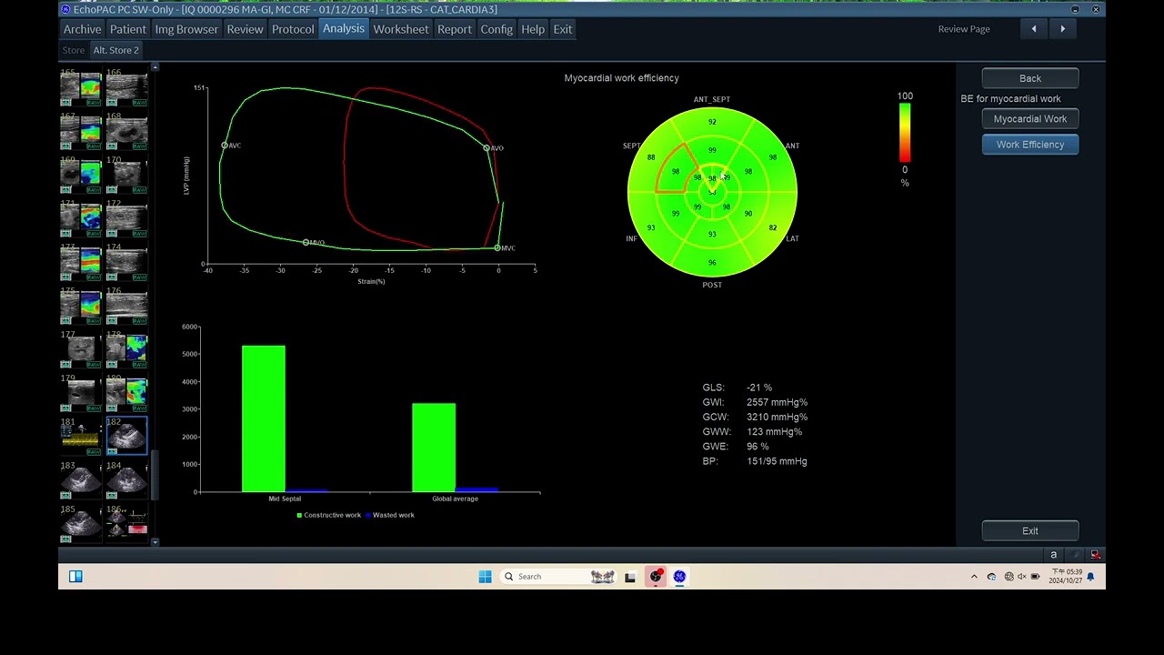 IQ 296 GWE GLOBAL LONGITUDINAL EFFICIENCY MYOCARDIAL WORK INDEX  ECHOPAC ANALYSIS ECHOCARDIOHRAPHY H
