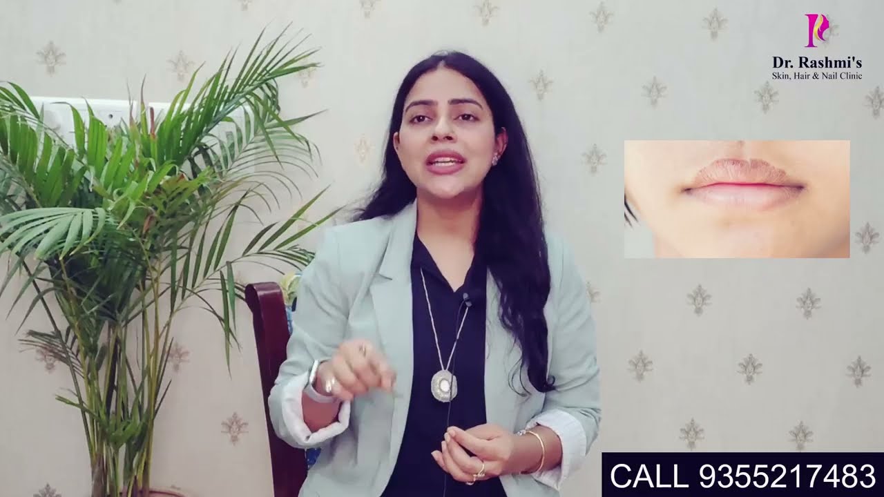 Lip licker's dermatitis is reaction of lips and surrounding skin