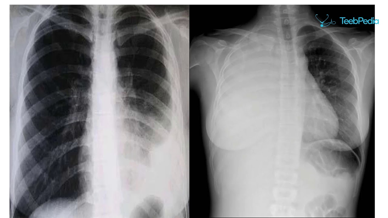 Tuberculose Extra-Pulmonaire - Pr Ketfi