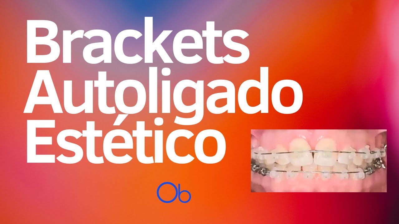 Brackets autoligado estéticos