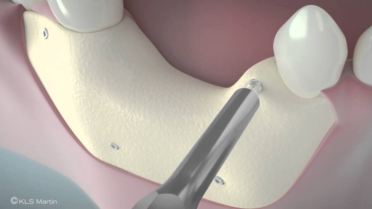 SonicWeld Rx® Dental – Shell technique for vertical defect augmentation