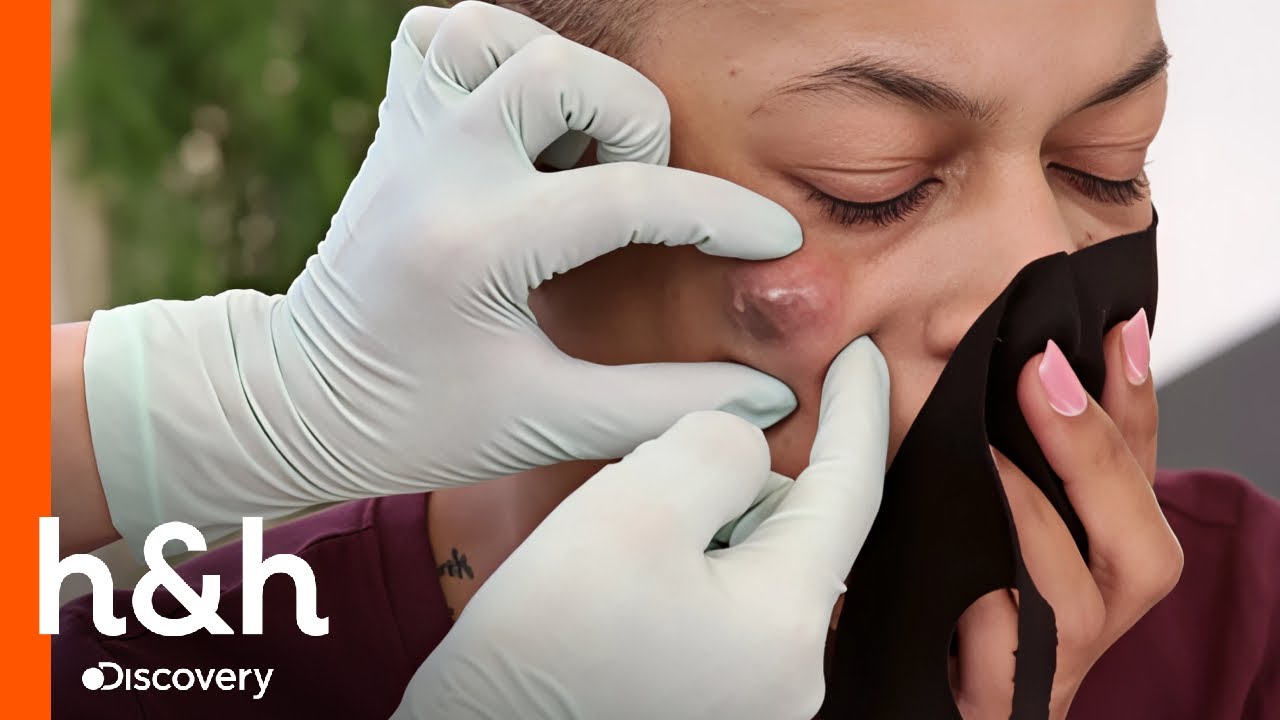 Punto negro en su rostro crece sin control | Dra. Sandra Lee: Especialista en piel | Discovery H&H