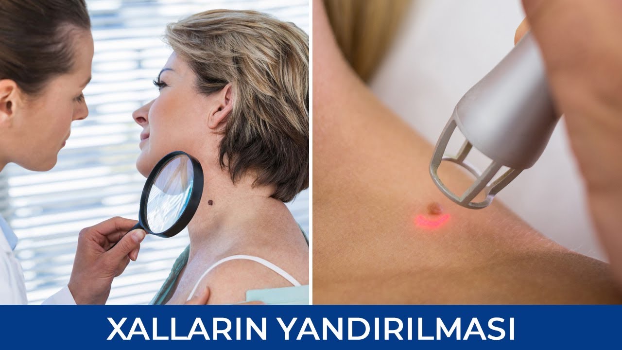 Xal Yandırma - Ət xalı - Quba Rüstəmova (Dermatoveneroloq - kosmetoloq )