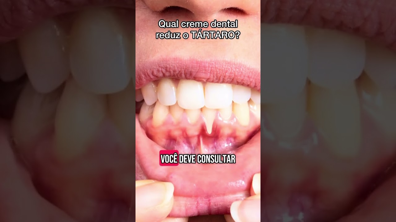Qual creme dental reduz a forma&ccedil;&atilde;o do t&aacute;rtaro?
