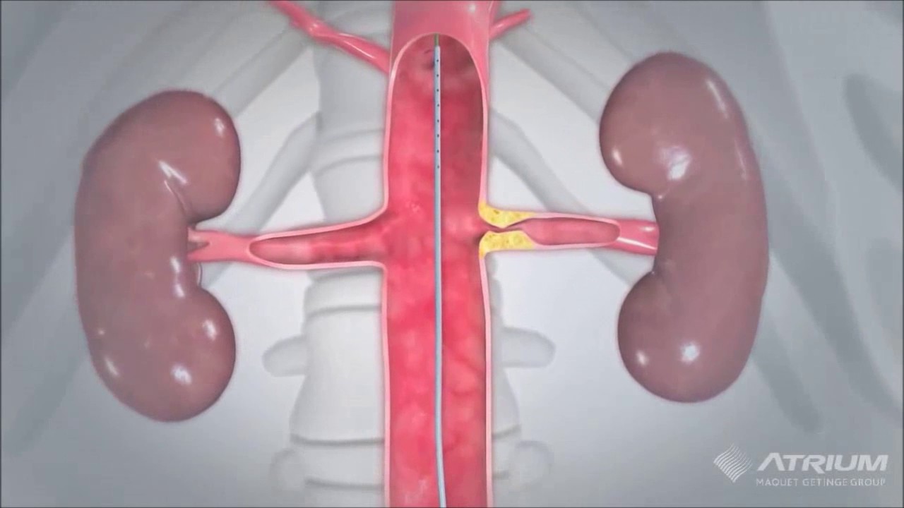 Aufdehnung einer verengten Nierenarterie mit Ballon und Einsetzen eines Stents