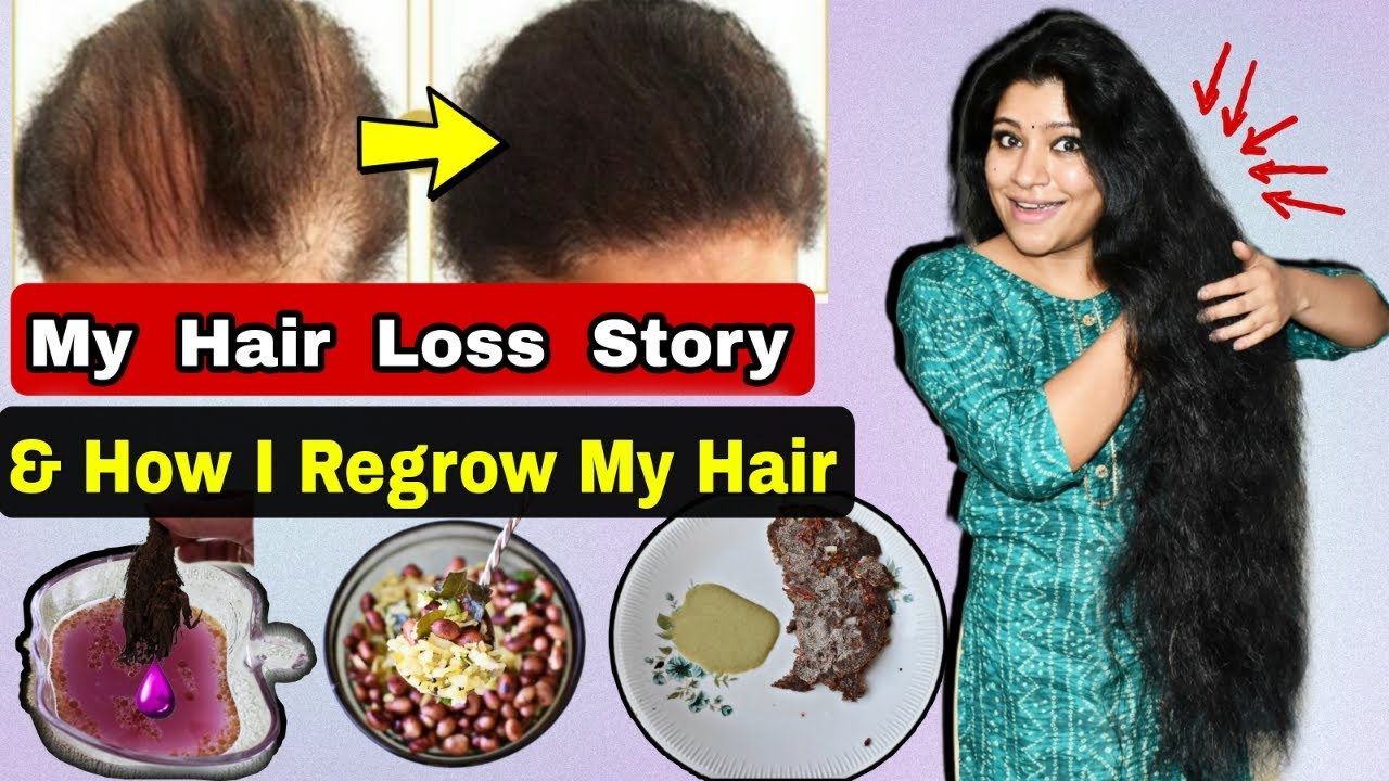 My Hair Loss Story(Mistakes,Remedies To Regrow Hair)मैंने खुद के बालों को कैसे बचाया ये ना करें कभी।