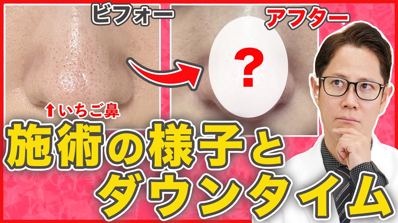 いちご鼻が改善！花房式毛穴治療の施術の様子とダウンタイムを全公開！