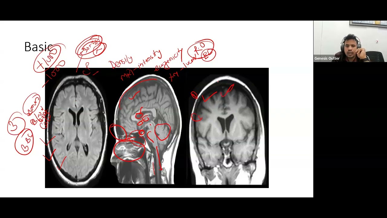 Mastering MRCP Topic Neuroimaging High Yield Topics for MRCP 2 EXAM