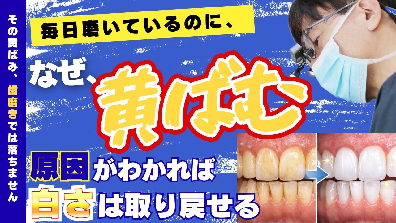 【歯の黄ばみ】毎日磨いているのになぜ？原因別に白い歯を取り戻す方法について岡山の歯科医師が解説します