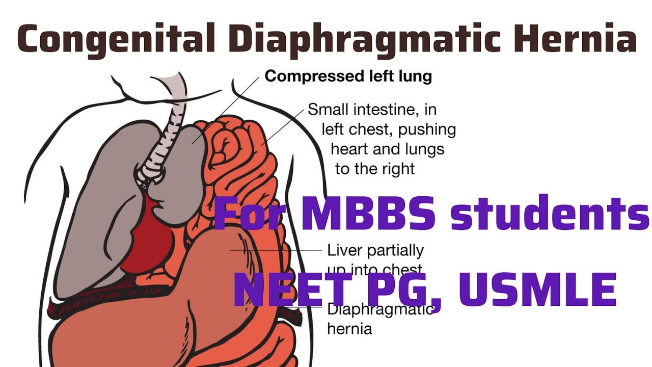 Врожденная диафрагмальная грыжа для студентов MBBS, Neet PG, Usmle I NeetPG Usmle Подготовка