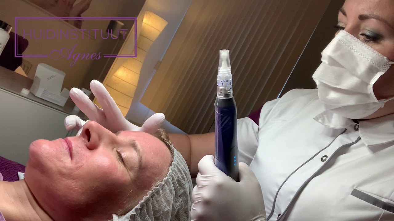 Skin-Pen behandeling