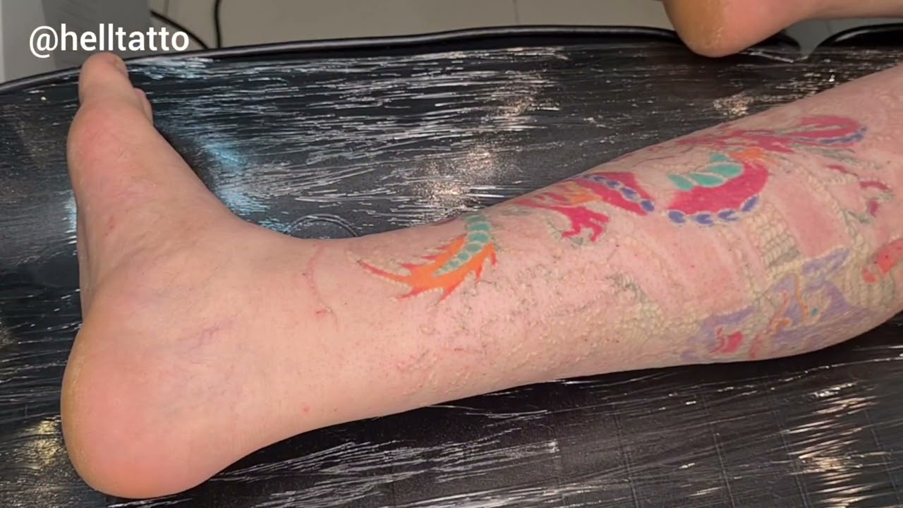 Remoção de Tatuagem colorida, veja o quanto é complicado de Remover uma tatuagem oriental grande