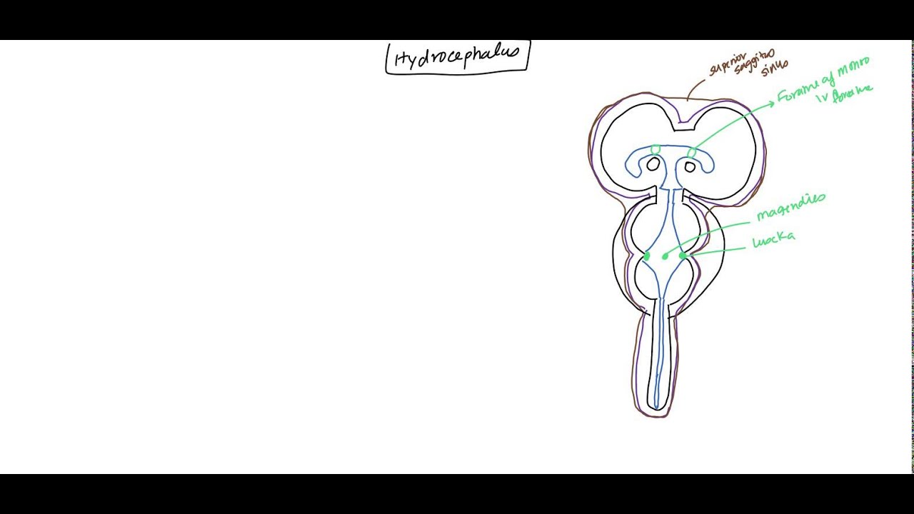 Hydrocephalus (NeuroAnatomy and Physiology of CSF) for USMLE