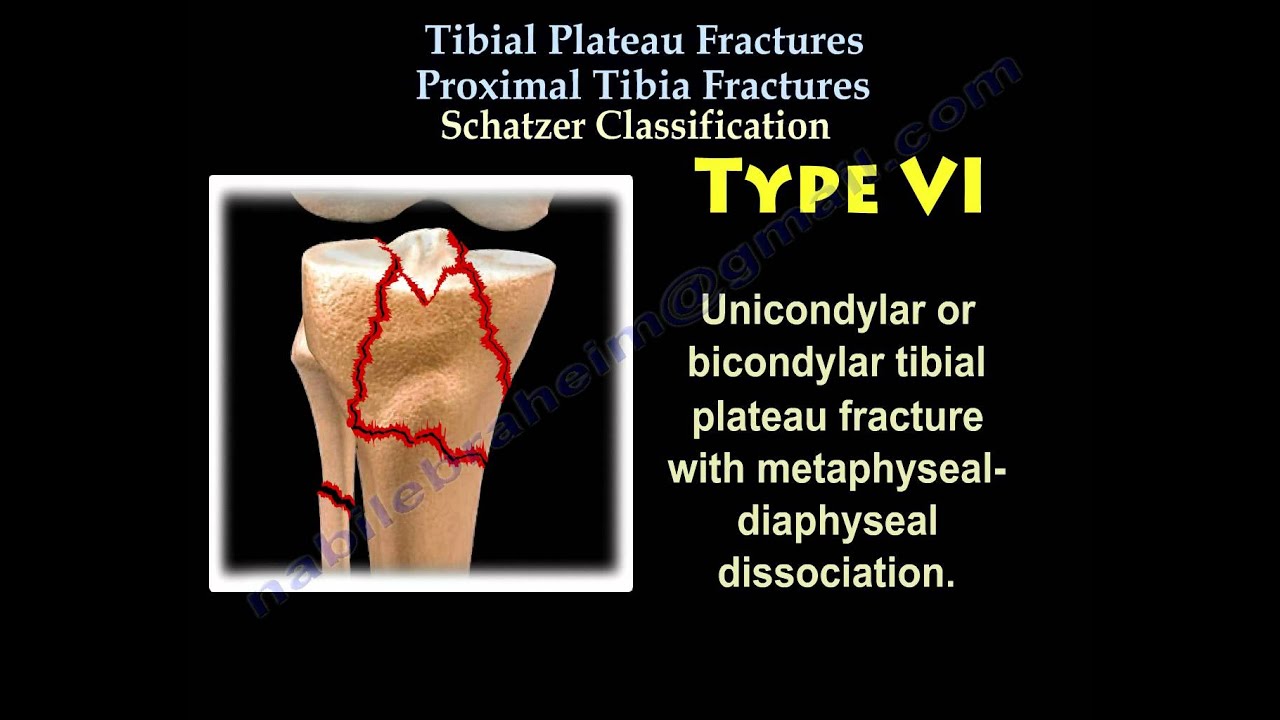 Tibial Plateau Fractures Proximal Tibia Fractures - Everything You Need To Know - Dr. Nabil Ebraheim