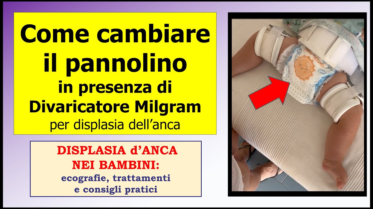 Come cambiare il pannolino con tutore Milgram per displasia dell'anca