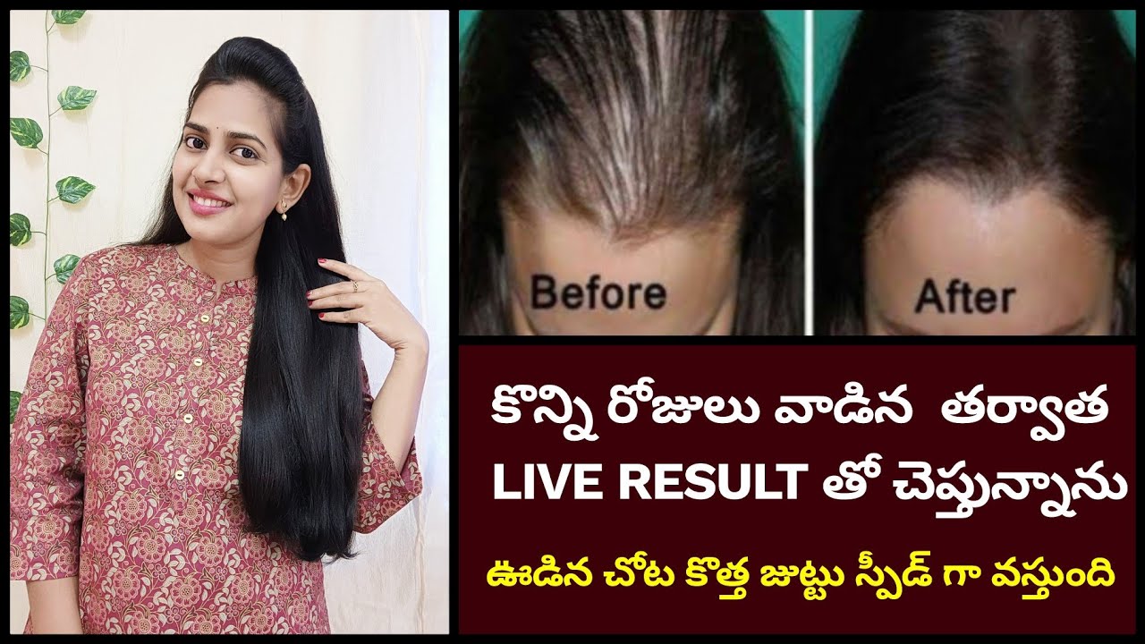 Fast Hair Growth Remedy |Get Long & Strong Hair in 30 Days with LA Organo Red Onion Hair oil,Shampoo