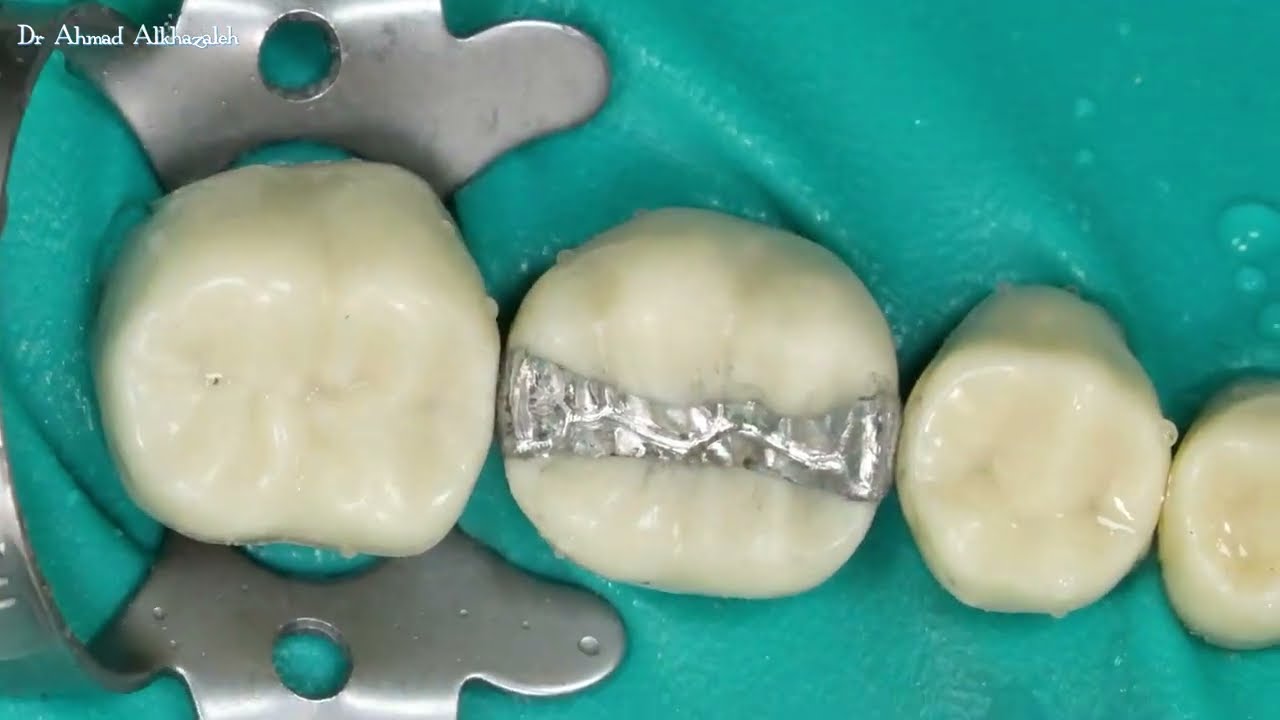 Amalgam restoration polishing steps