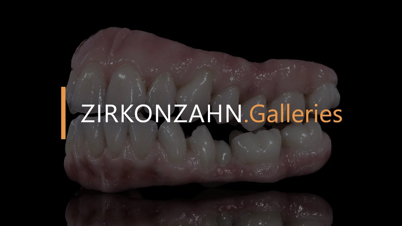 Prettau® Bridge made of Prettau® 2 Dispersive® on Anodised Titanium Bar | Zirkonzahn.Galleries