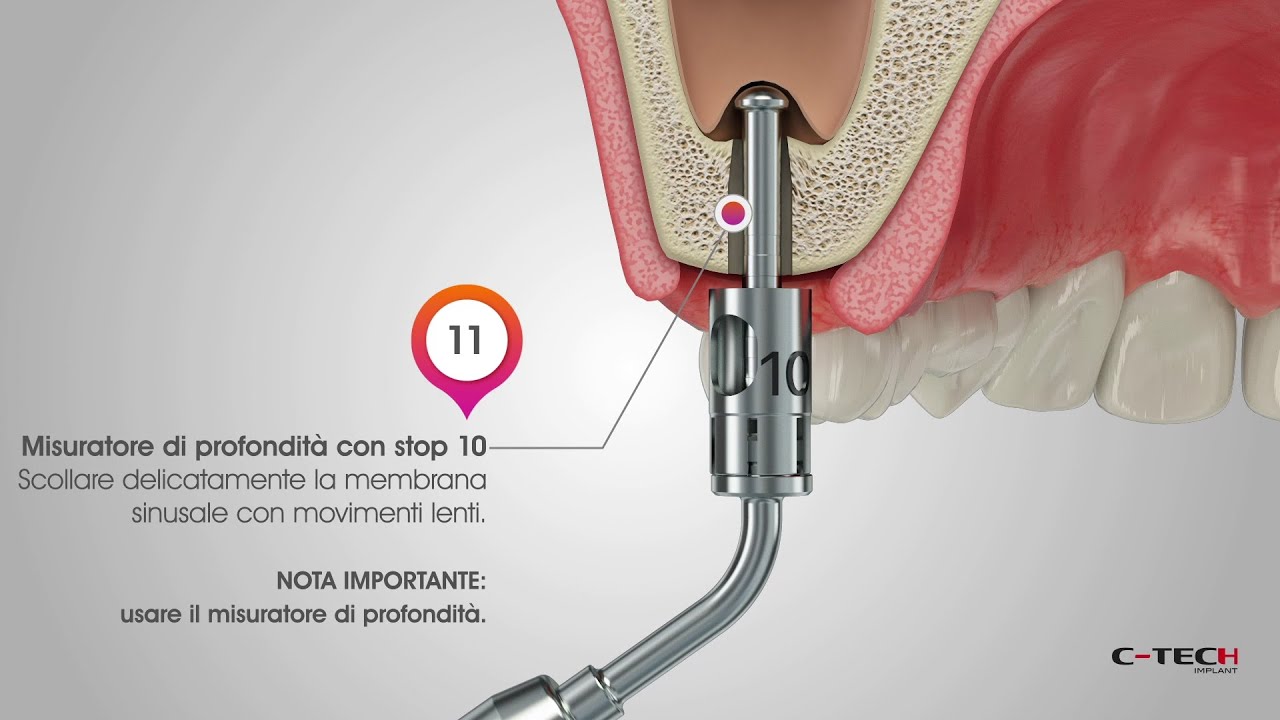 Crestal Sinus Lift - ITA
