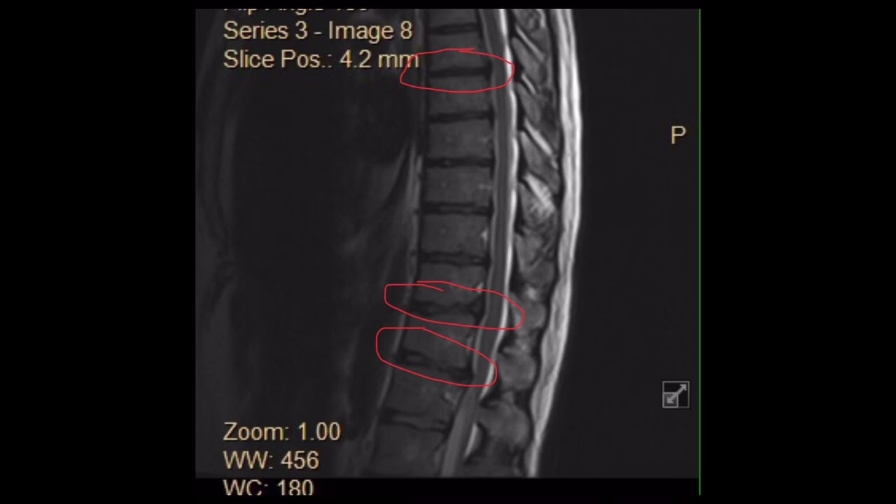 Stem Cell Intradiscal Lumbar Disc Bulge Thoracic Degenerative Disc DDD Injections Regenexx Cayman