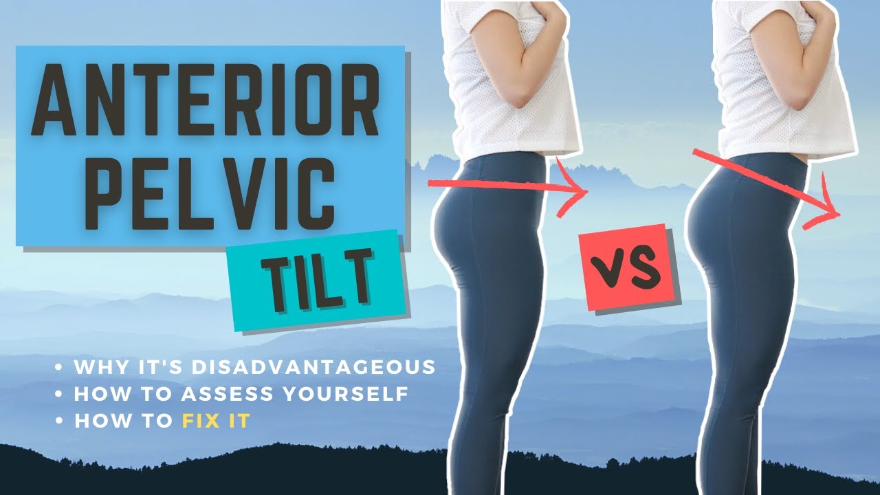 How to Self-Assess & Fix Anterior Pelvic Tilt in 10 Minutes