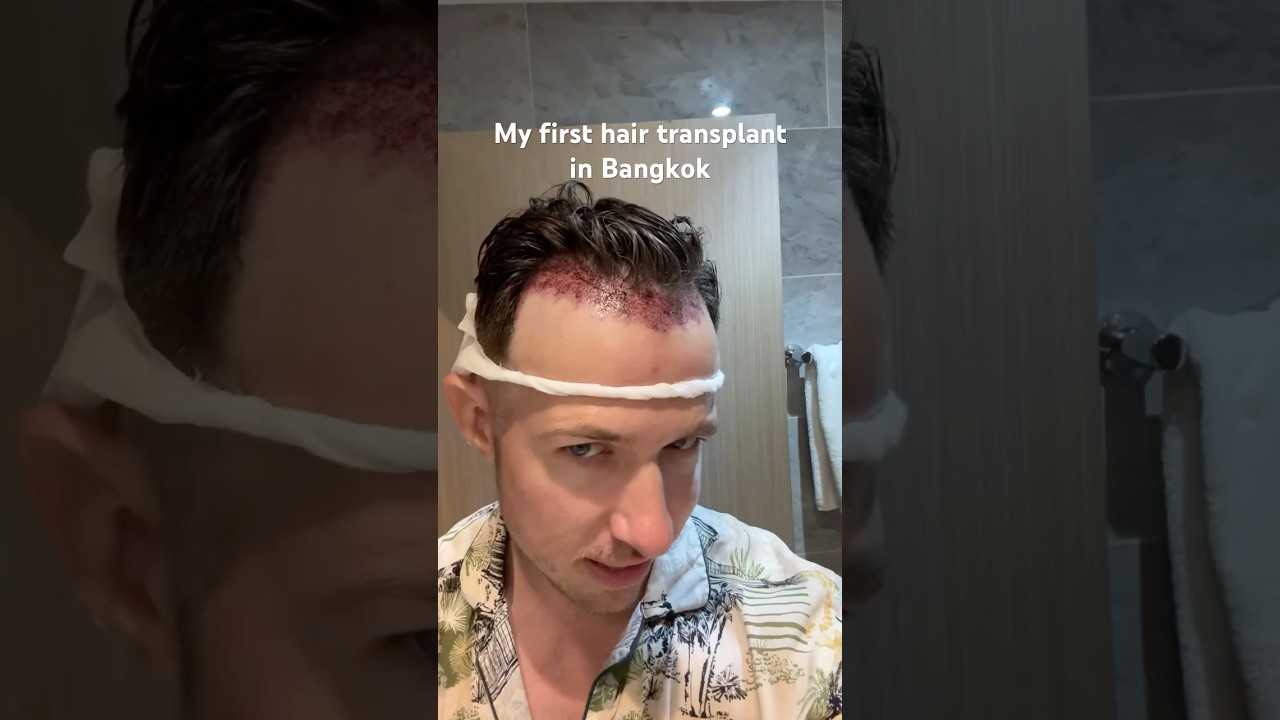 My first hair transplant in Bangkok with amazing results ! 😍 #hairtransplant #hairrestoration