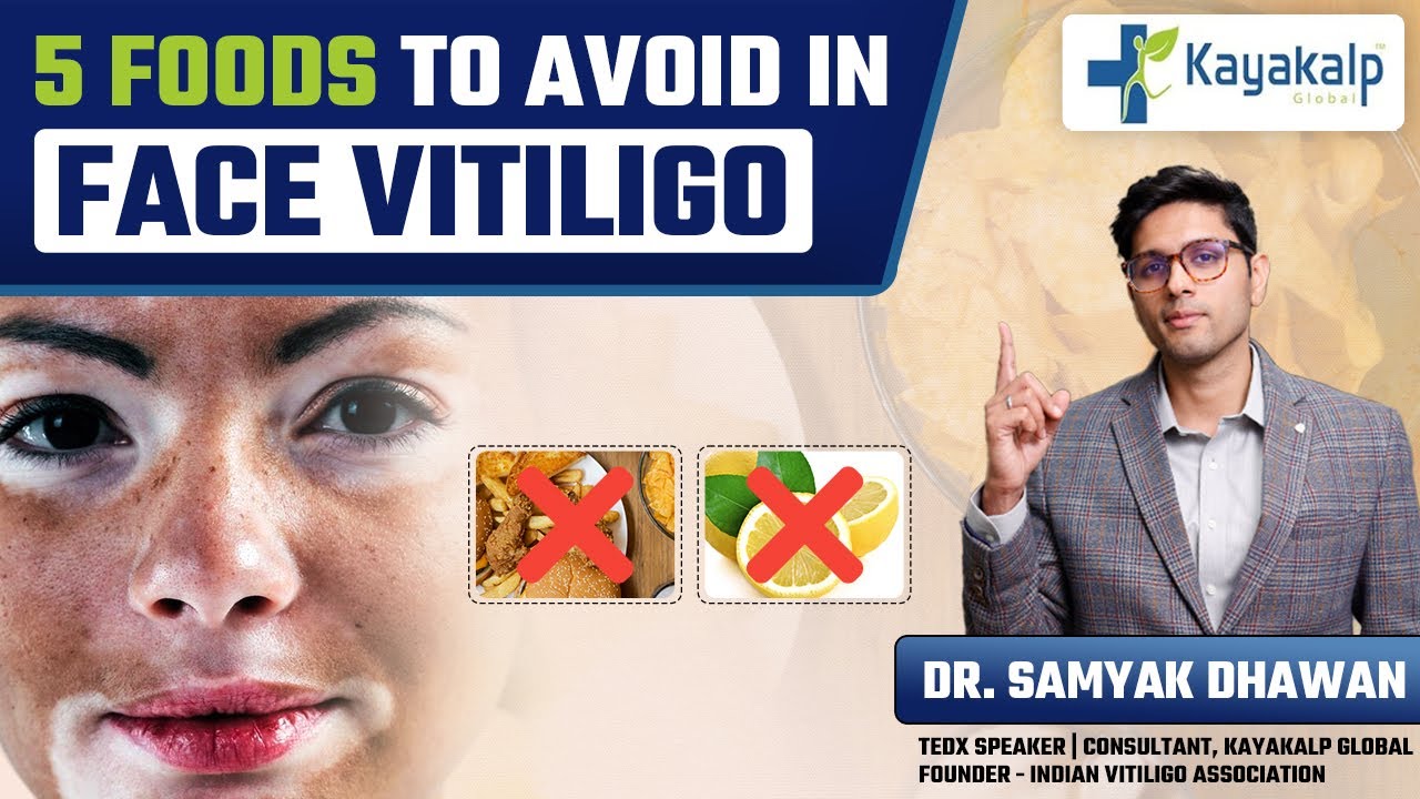 चेहरे के सफ़ेद दाग में यह 5 चीज़े तुरंत बंद करें! | Face Vitiligo Treatment in India | Kayakalp Global