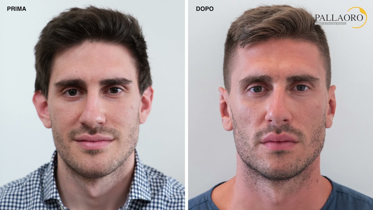 Otoplastica, Mattia ha corretto le orecchie a sventola