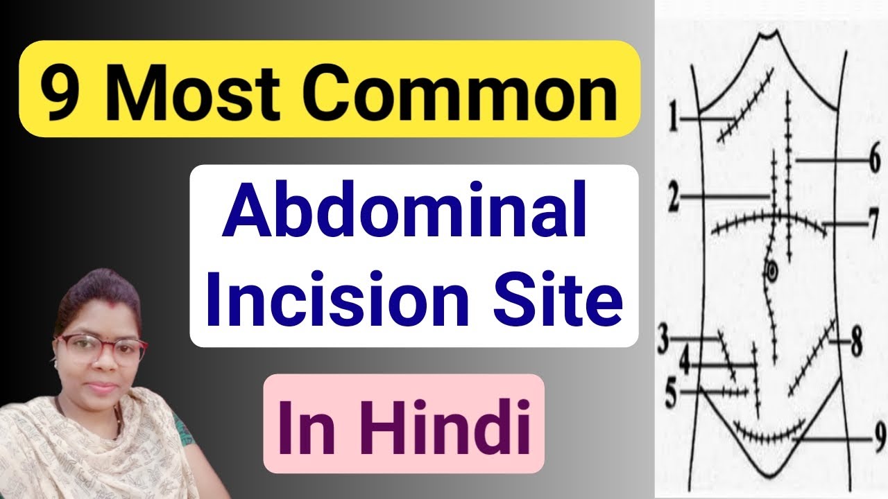 Common Abdominal Incision In Hindi | Abdominal Incisions | You Should Know Abdomen Incision Types |