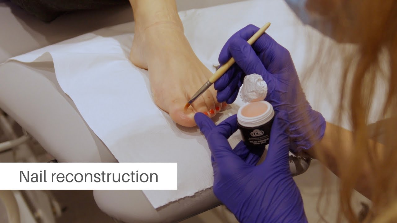 Nail reconstruction at Flawless Feet Podiatry in London