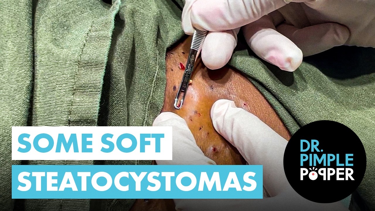 Some Soft Steatocystomas