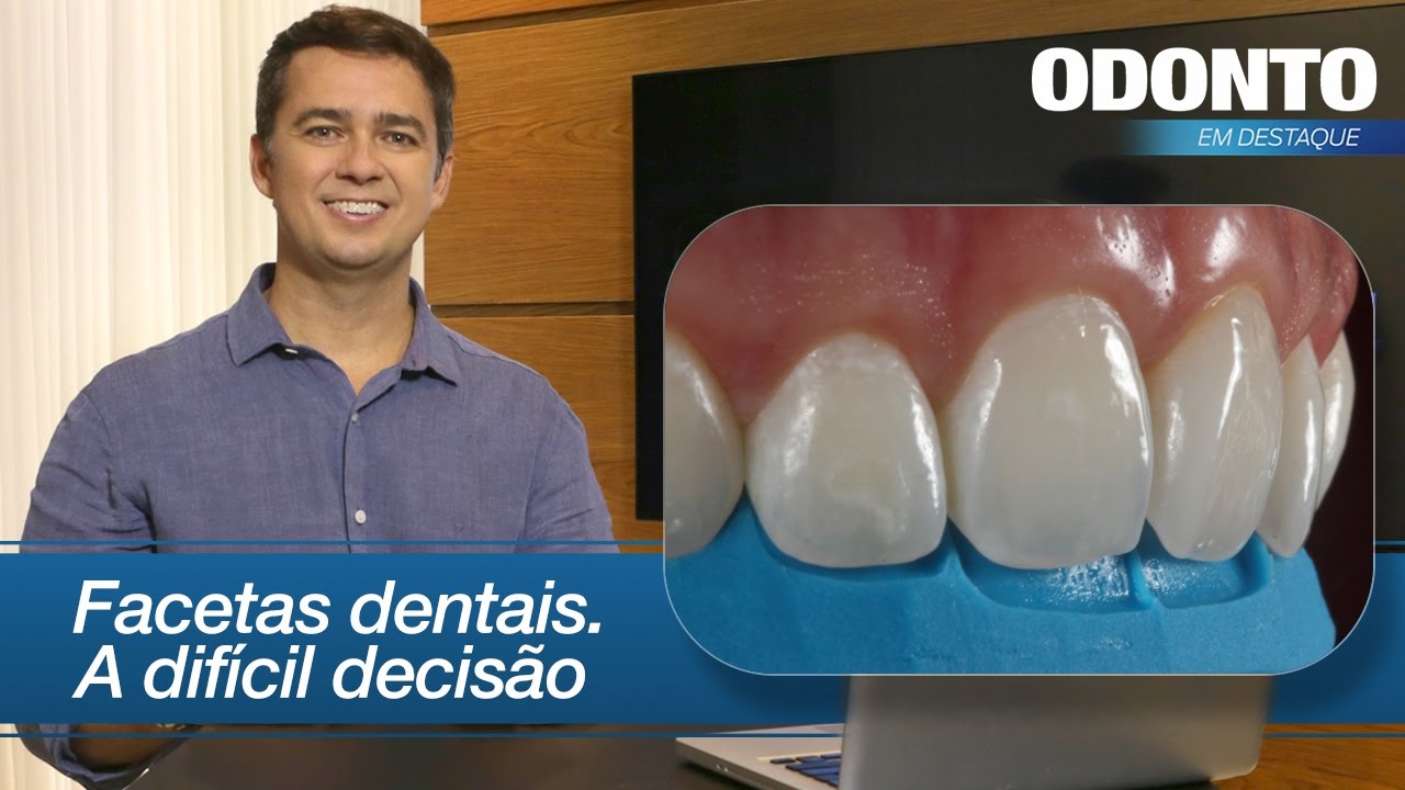Facetas Dentais: A Difícil Decisão | Leonardo Muniz