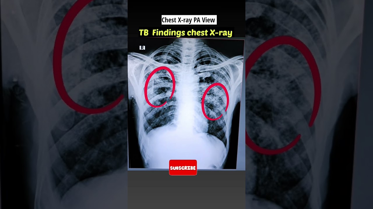 TB hone par Chest x-ray  kaisa dikhta hai ? #xray #shorts