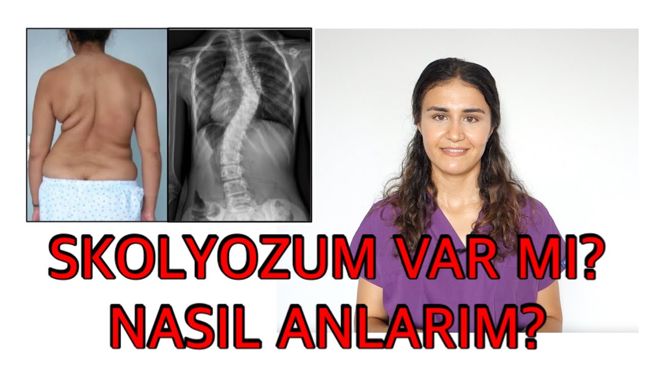 SKOLYOZUM OLDUĞUNU NASIL ANLARIM?