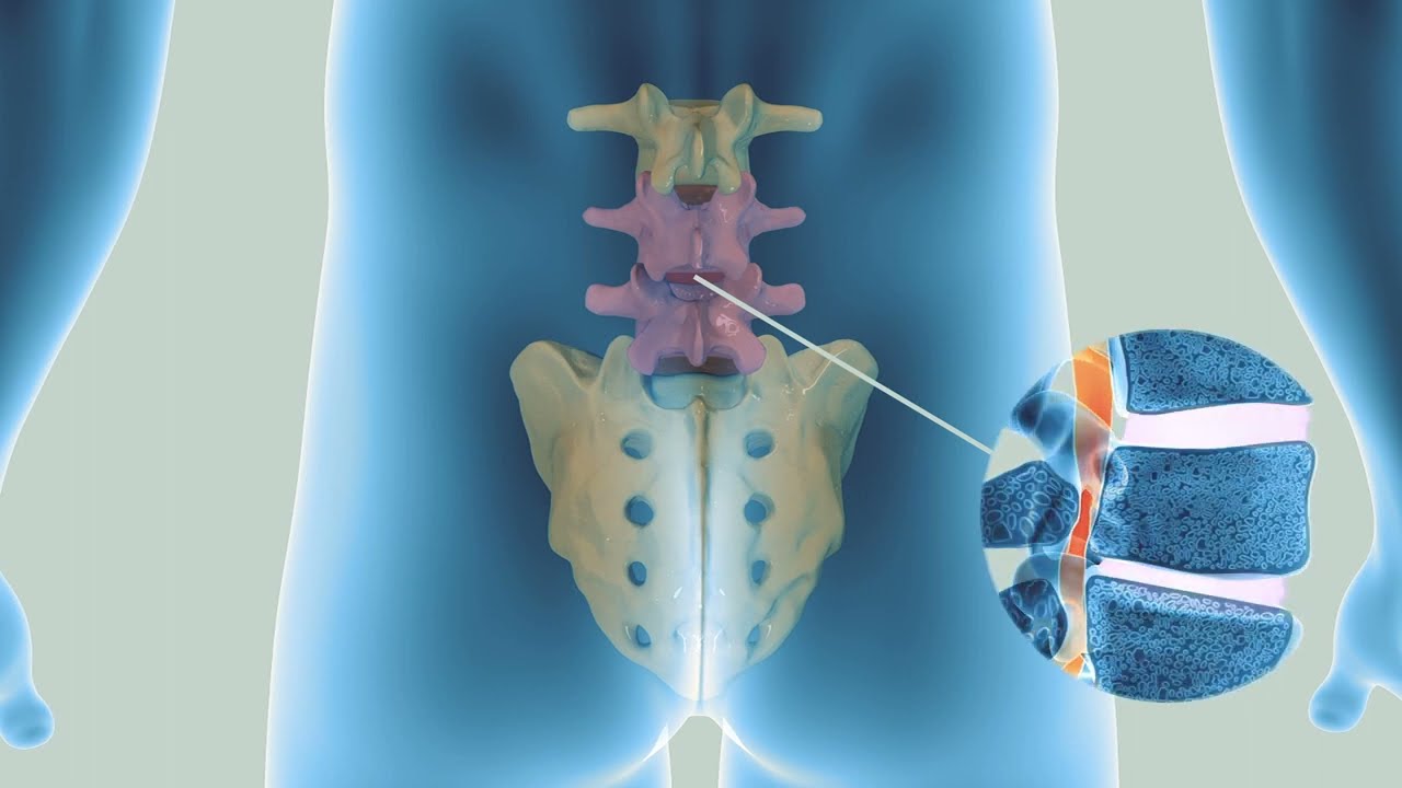 Trattamento Mini Invasivo della Stenosi Lombare | Clover