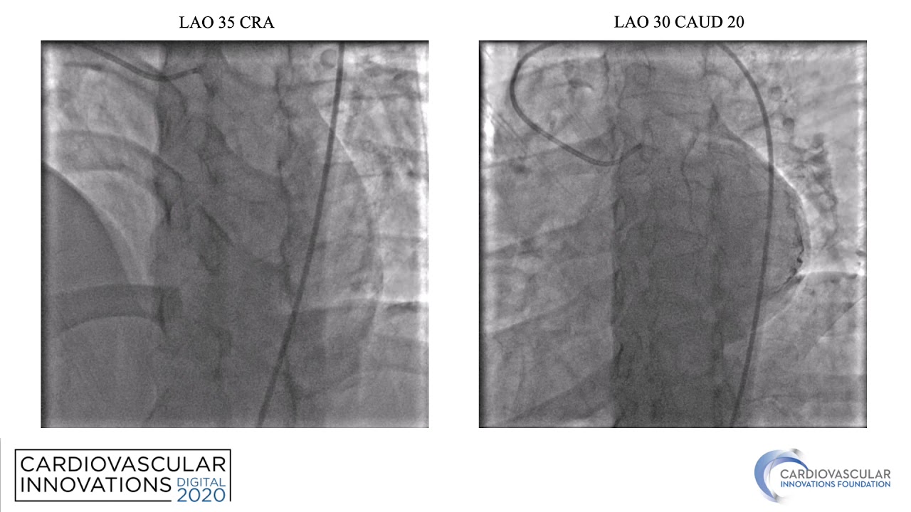 Mittal_Coronary Artery Fistula: Pre-conal and Retro-conal Artery Ring_Coronary