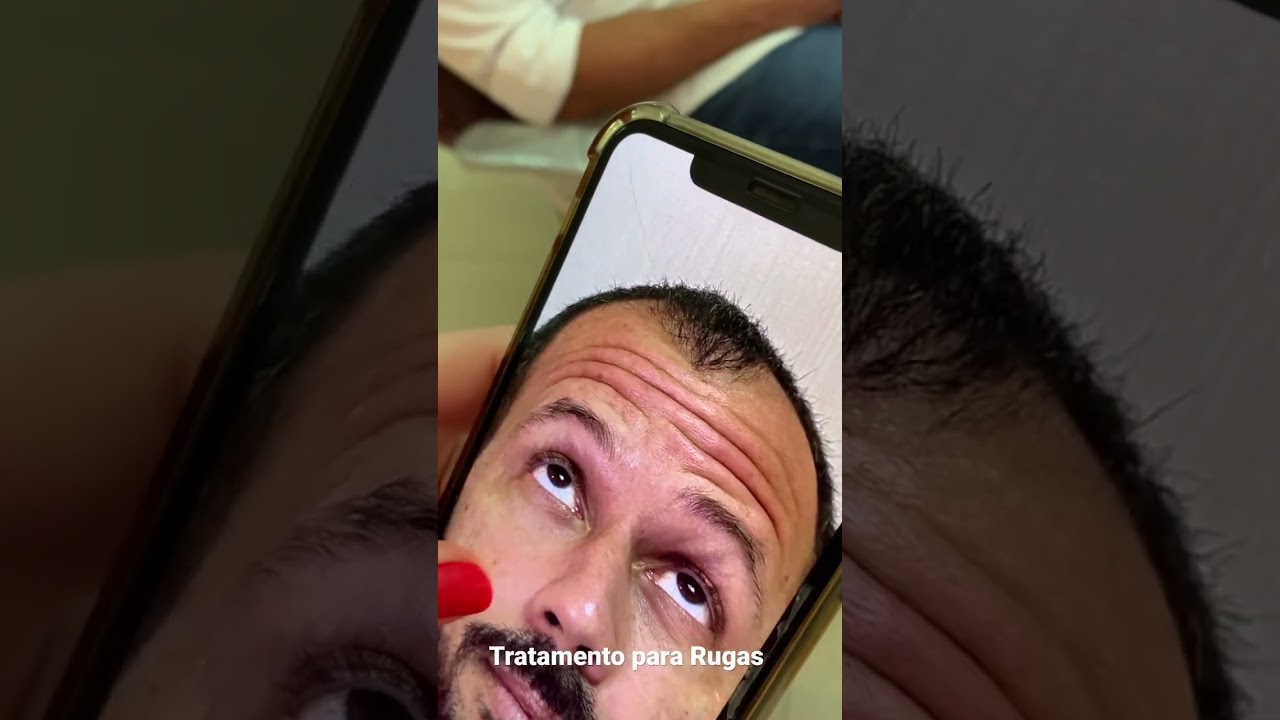 Tratamento para rugas com toxina botulínica em homens