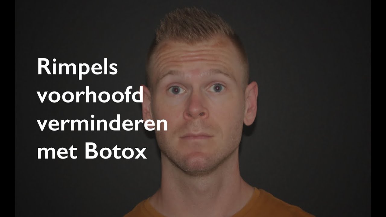 Rimpels voorhoofd: voorhoofdrimpels verwijderen met Botox