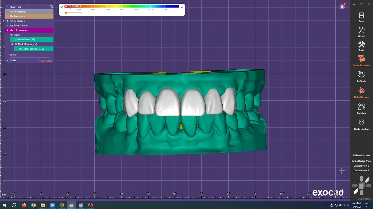 Exocad Mockup Design on Tooth 13 - 23 ( 6 Unit ) - Export STL File to 3D Print Model