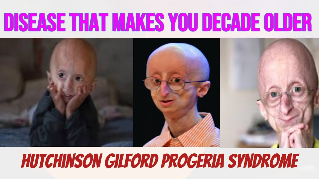 The disease that makes you decade older || progeria explained || Rare disease ||
