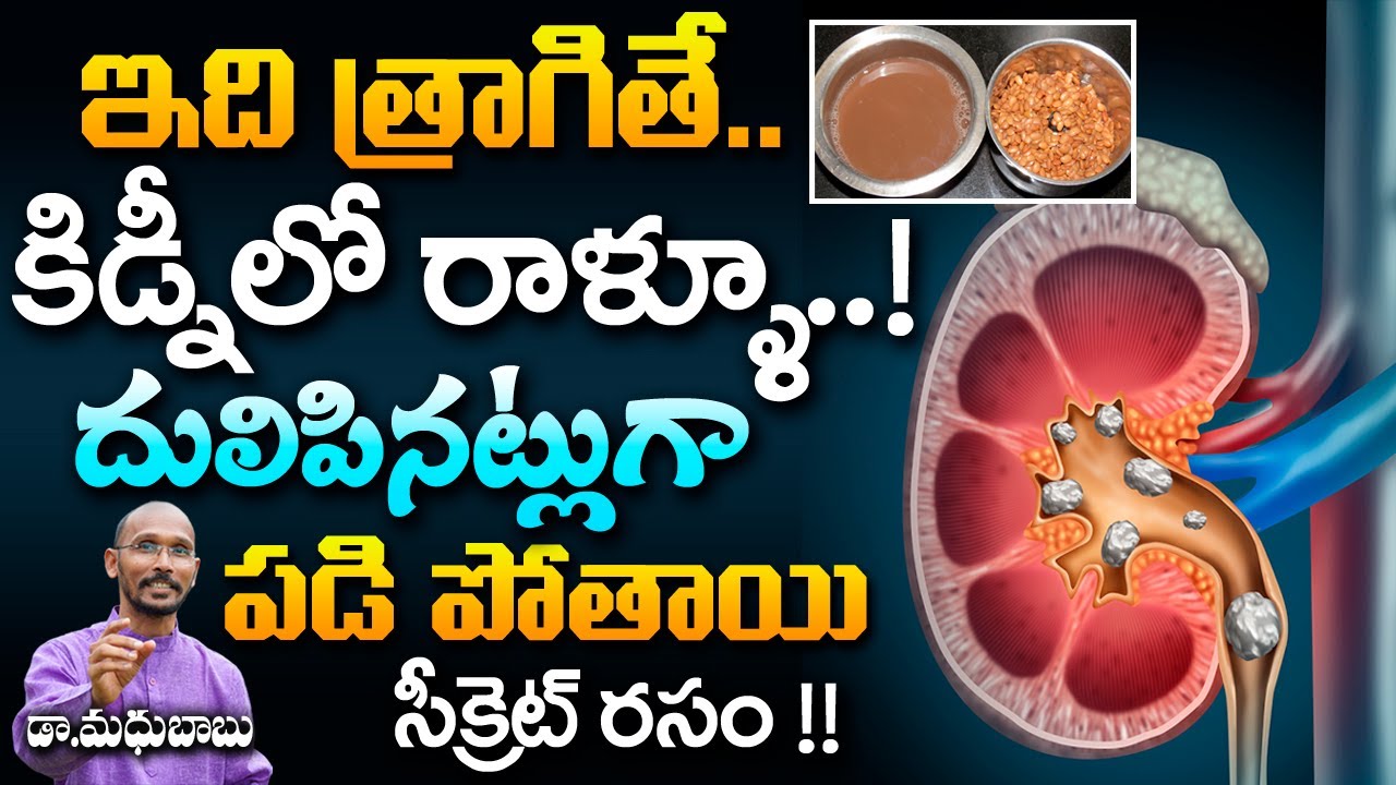 కిడ్నీలో రాళ్ళూ దులిపినట్లుగా పడి పోయే సీక్రెట్ రసం !! | Dr. Madhu Babu | Health Trends |