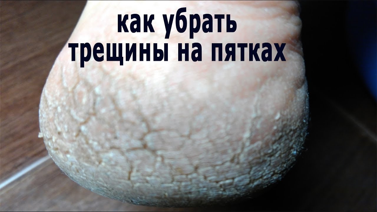 ★Пятки как у младенца. Простой рецепт убрать трещины на пятках.