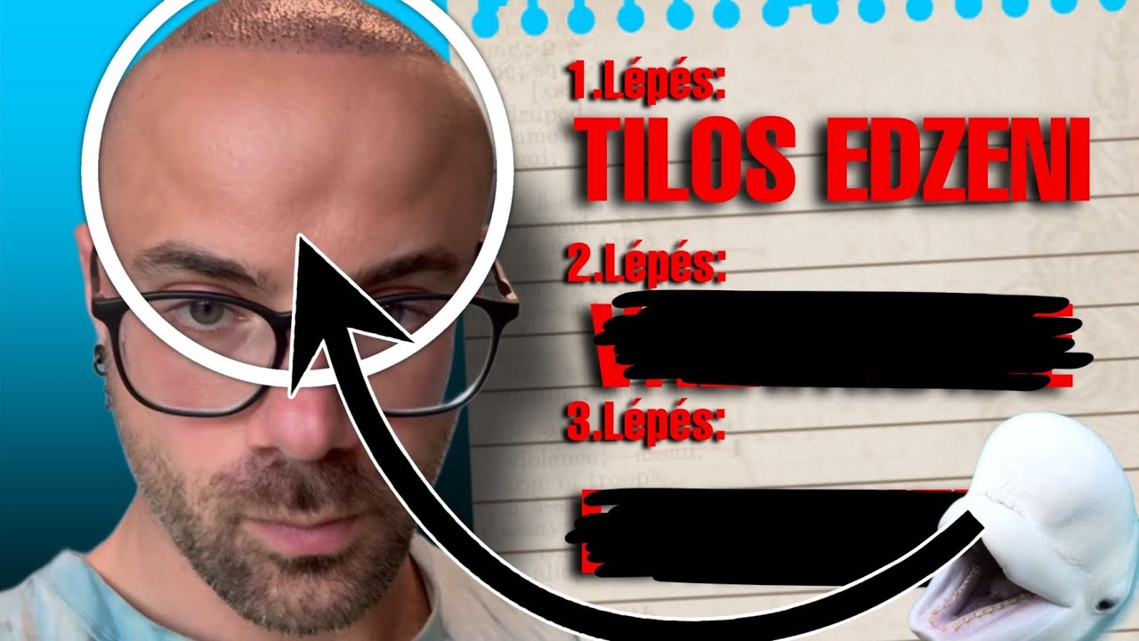 EZ TÖRTÉNT hajbeültetés után... (és ezekre nagyon figyelj...)