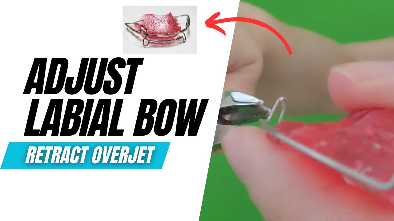 Adjust a Labial Bow in a Hawley
